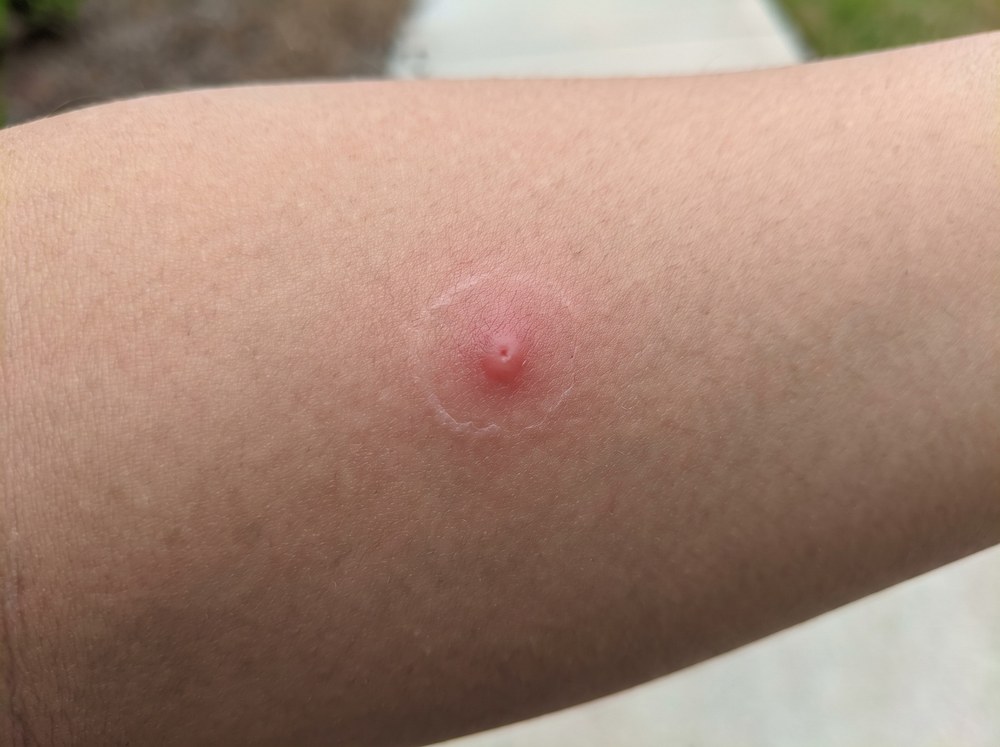 Close-up of a fire ant sting cluster on skin showing red welts and a developing white pustule at the center of each mark